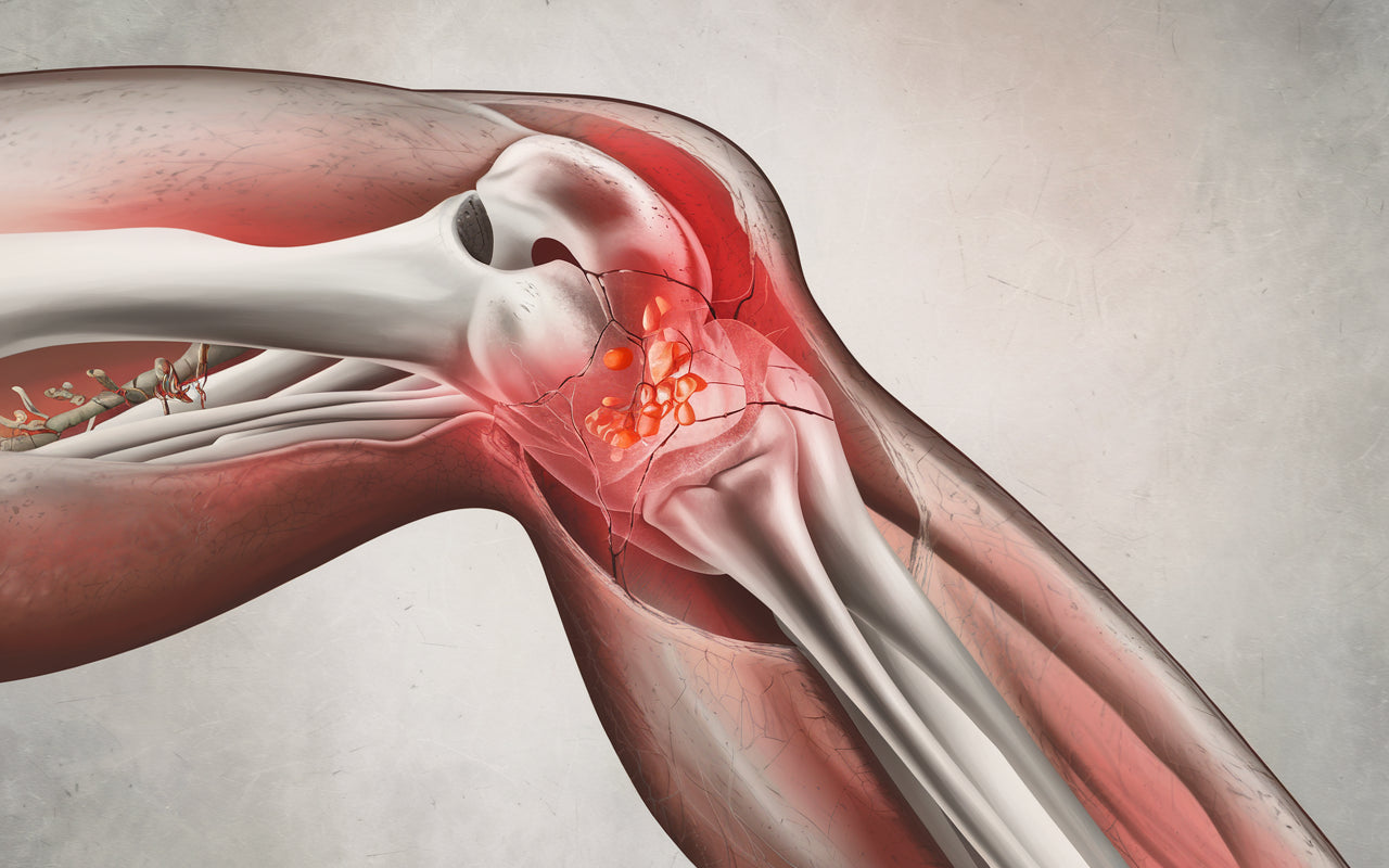 Gikt är en smärtsam form av artrit som orsakas av höga nivåer av urinsyra i blodet