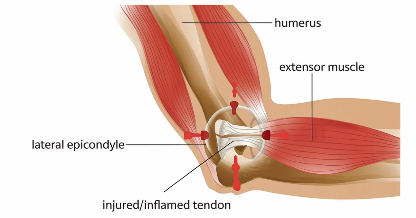 Tennisarmbåge, även kallad lateral epikondylit